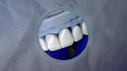 تکنیک لیرینگ چیست؟