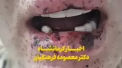 شلیک پدرشوهر به دهان عروس؛ شرح وضعیت مصدوم از زبان پزشک