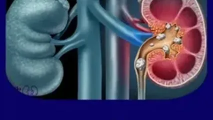 چه کار کنیم که دچار ابتلا به سنگ کلیه نشویم؟