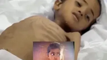 شهادت دختربچه فلسطینی بر اثر گرسنگی در غزه