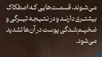 این علامت در پوست نشانه قند خون بالاست